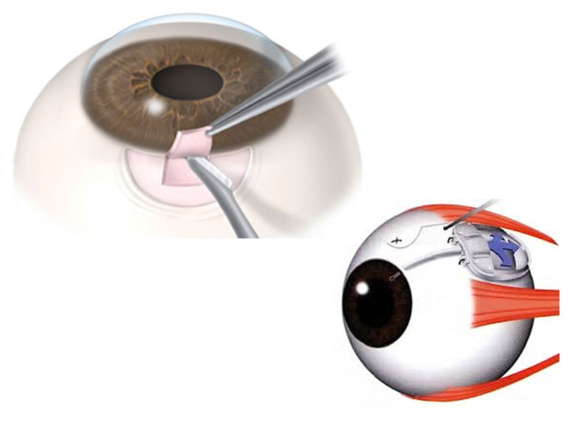 Glaucoma (Trabeculectomí­a e Implante Valvular)